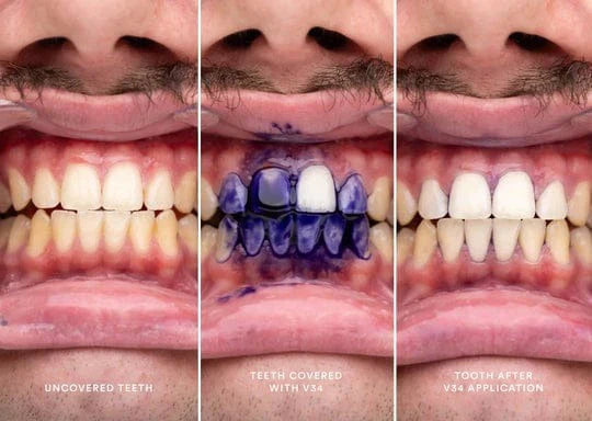 HiSmile V34 Teeth Whitening Serum